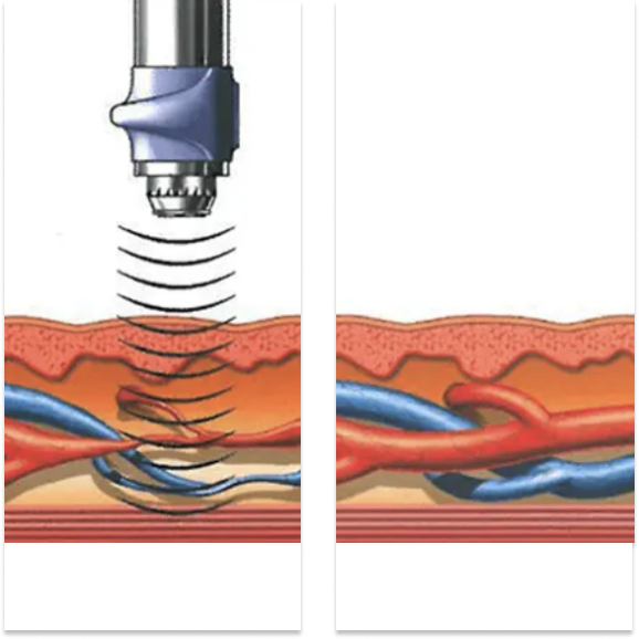 How Does GAINSWave Work St. Louis